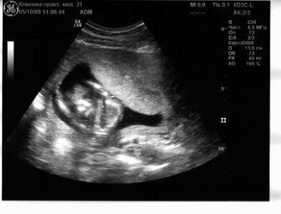 16 неделя беременности фото узи