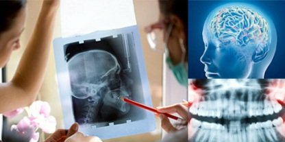 Рентген зубов повышает риск развития рака мозга